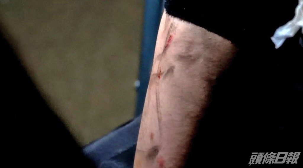 AL報平安表示只係皮外傷，唔係好痛。